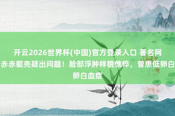 开云2026世界杯(中国)官方登录入口 著名网红董赤赤躯壳疑出问题!脸部浮肿样貌憔悴,曾患低卵白血症